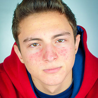 Rosacea