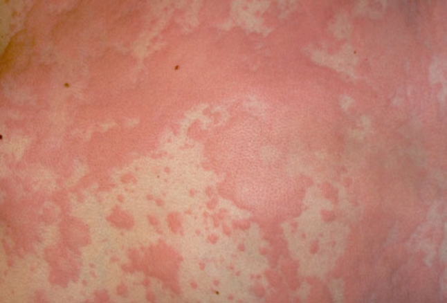 Urticaria ili Koprivnjaca